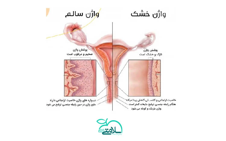 خشکی واژن چیست و چگونه درمان می‌شود؟